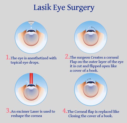lasik-surgery-phagwara