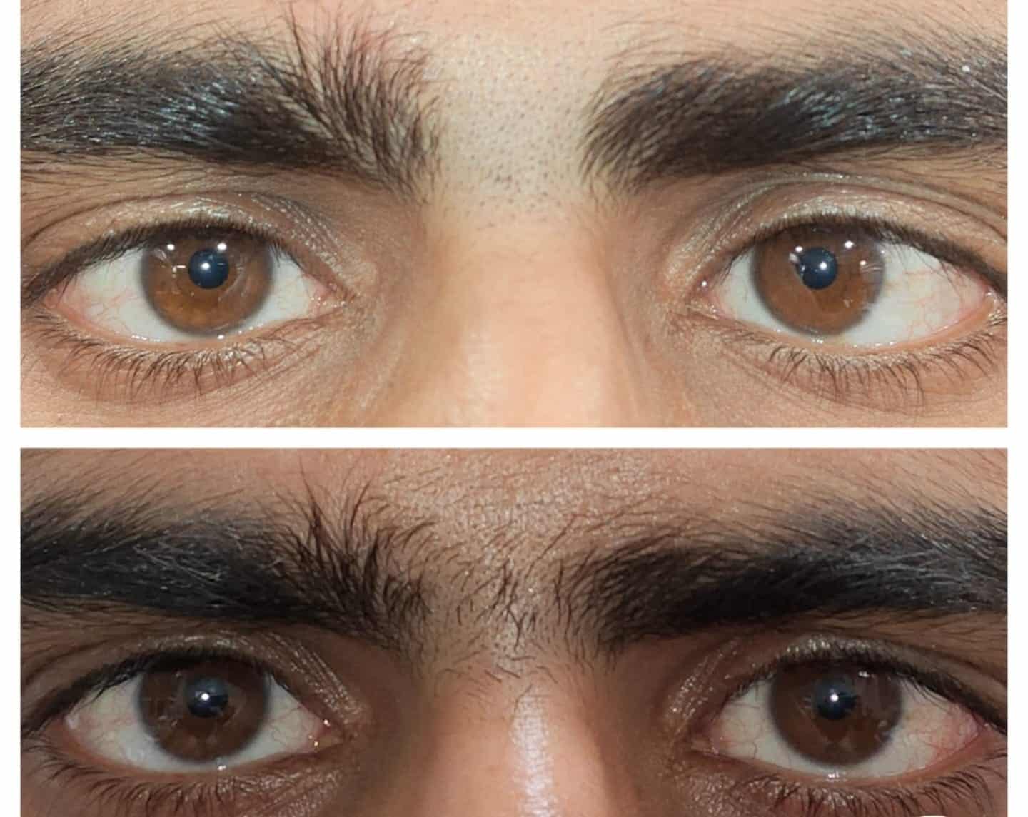 Close-up of eyes showing before and after LASIK eye surgery results.