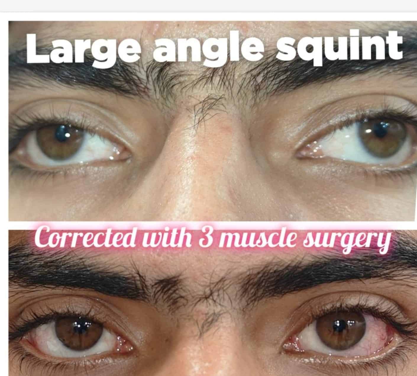 Close-up of eyes showing large angle squint corrected with muscle surgery.